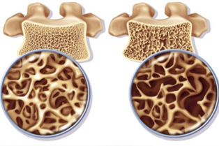 osteoporosi